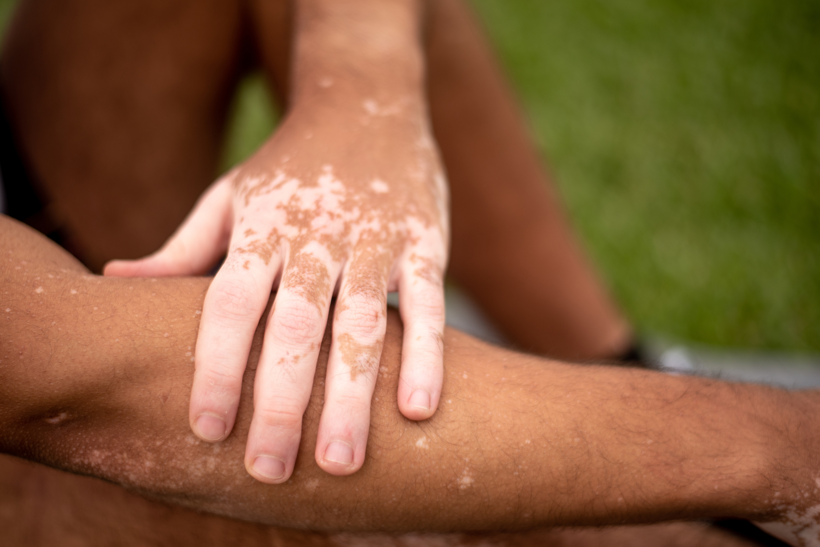 Vitiligo