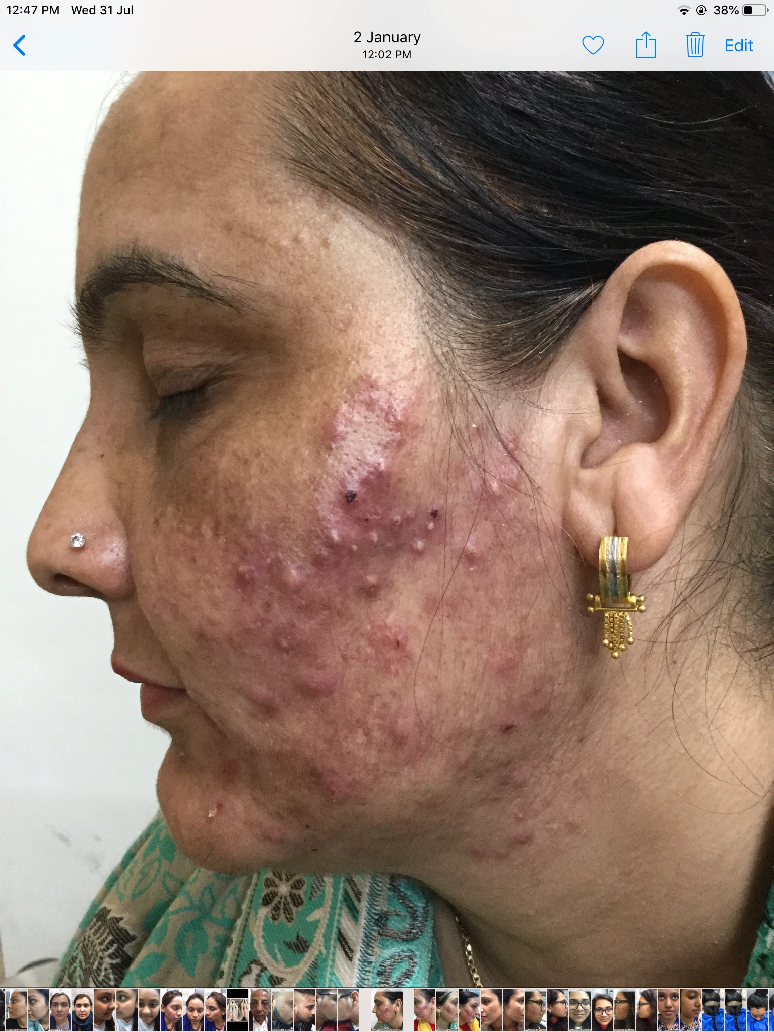 Acne (before)