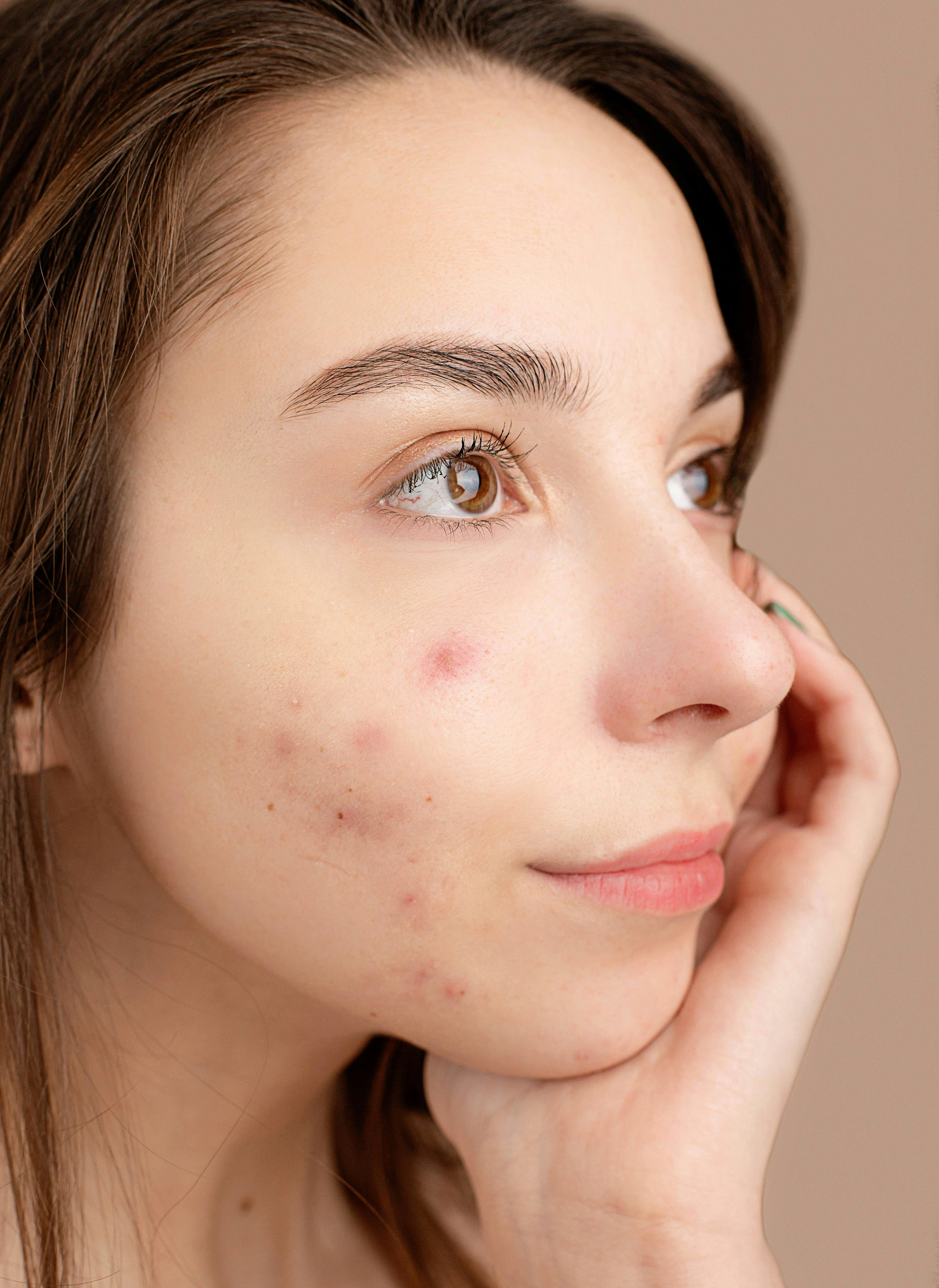 Acne Scars